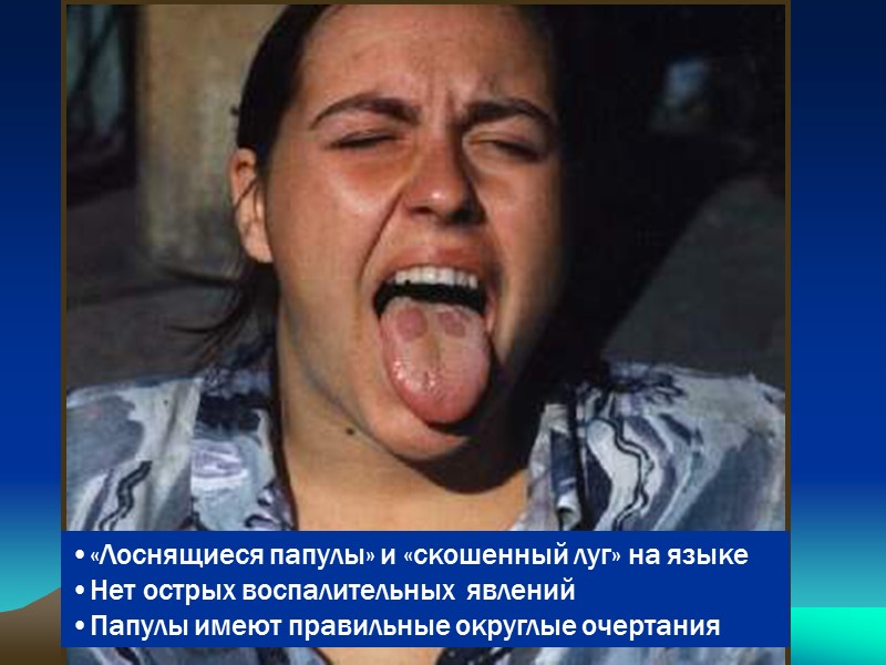 «Лоснящиеся папулы» и «скошенный луг» на языке Нет острых воспалительных  явлений Папулы имеют